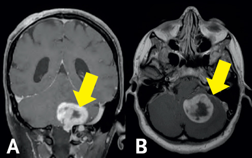 (Left) Gray colored variations are surrounded by a black and white outline. In the bottom right of the figure, there is a white blob highlighted by a yellow arrow. This blob is at the top base of a vertical dark gray column at the bottom of the image. (Right) Two dark gray spheres are conjoined at the bottom of the image. A white blob sits above the right sphere with a yellow arrow pointing towards the blob. Above the spheres are gray colored structures. All structures are enclosed by a white boarder.