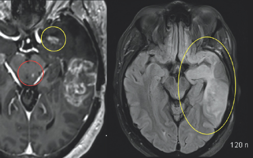 Variations of gray color are enclosed by a white outline. In the center of the image, there is a very small white blob highlighted by a red circle. In the top right of the image, there is a white colored blob highlighted by a yellow circle. (Right) Gray colored variations are enclosed by a black and white outline. To the right of the image, there is a significantly large white blob highlighted by a yellow oval. 