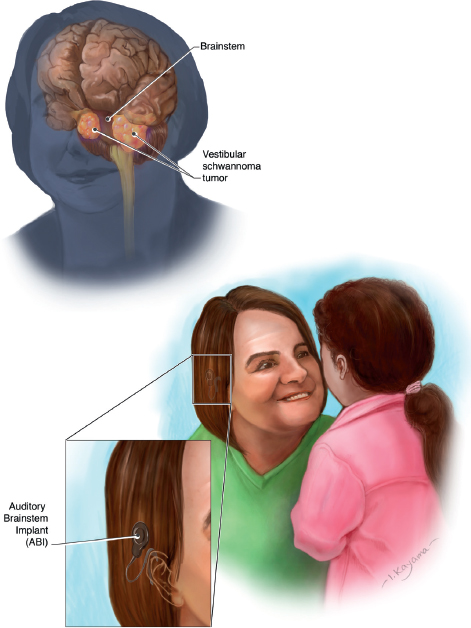 (Left) A woman's head and neck are translucent in blue. A pink colored brain is connected to a brown colored stalk at the base. Two peach-colored blobs are located on either side of the brain towards the stalk. (Bottom) A brown haired woman wearing a green shirt is smiling at a child. The child is positioned with her back to the viewer. She is wearing a pink jacket and has a pink ponytail in her hair. Beneath the woman's translucent brown hair is a gray circular shaped device attached to her right ear with a wire. A zoomed in picture of this device is shown to the left side of the woman.
