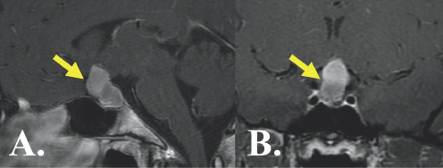 (Left) A yellow arrow points to a light gray blob in the center of the image. It is surrounded by black and gray color variations depicting brain structures. (Right) A yellow arrow points to a light gray blob in the center of the image. It is surrounded by black and gray color variations depicting brain structures.