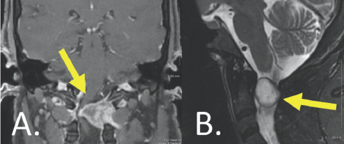 (Right) A large sized white blob is shown attached to a grey vertical column. A yellow arrow points to this white blob. Both structures are surrounded by other gray structures. (Right) A white spherical blob is highlighted by a yellow arrow. This blob is located in the center of the image overlapping a light gray colored column. These structures are surrounded by other gray and white structures.