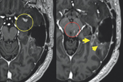 (Left) A variation of gray colored structures are surrounded by a black and white outline. On the top right of the image, there is a small white blob highlighted by a yellow circle. (Right) A variation of gray colored structures are surrounded by a large black and white outline. There is a small white blob in the center of the image highlighted by a red circle. There are two additional gray blobs with white coloration on them highlighted by two yellow arrows on the right side of the image.