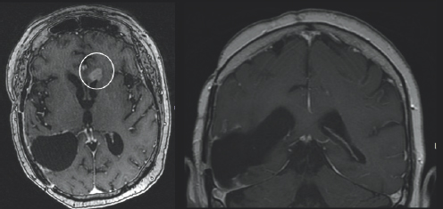 Light gray color variations are surrounded by black space and a white outline. On the top right of the image, near the midline, there is a white blob highlighted by a white circle. (Right) Charcoal gray color variations are surrounded by black space and a light gray outline.
