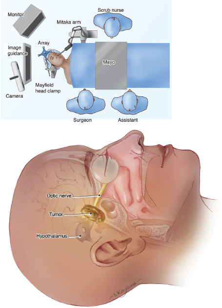 (Top) The bird's-eye-view of a patient lying on an operating table with a robotic arm going into their right nostril. The patient is wearing a surgical hair net and is covered by a blue blanket. Their head is secured by a medical device. Two doctors are standing on the right side of the patient and a nurse is standing to the left of the patient. The doctors and nurse are wearing blue colored gowns and surgical caps. Two monitors and a camera face the doctors and nurse above the patient's head. (Bottom) The right side of a human head lying flat is translucent with structures of the brain. A mauve colored structure is shown diagonal to the ear which connects to the closed eye by a yellow tube. A brown blob sits on this yellow tube between the structure and the closed eye.