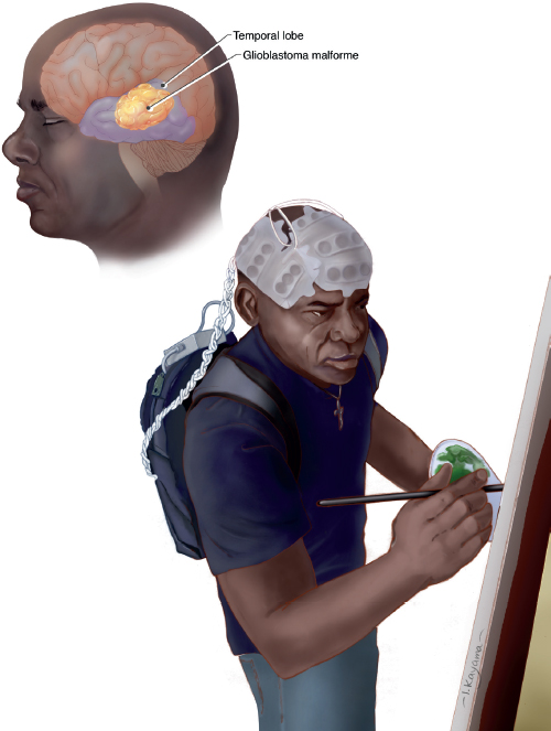 The left side profile of a man's head is translucent with a pink brain. The temporal area is purple in color with a large orange and yellow colored blob in the center of it. The brain stem and hindbrain are shown as well. (Right) A man is painting with green paint on his paintbrush and pallet on canvas. He is wearing a navy backpack with white and gray colored cords attached to light gray colored adhesives on his bald head. The man is wearing a cross necklace with a navy t-shirt and jeans.