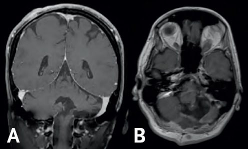 (Left) Gray colored variations are enclosed by a white outline. There is a dark gray column at the bottom of the image in the middle connecting the gray area to the bottom of the image. (Right) Gray and white colorations are depicting normal brain structures; all are surrounded by a white boarder.