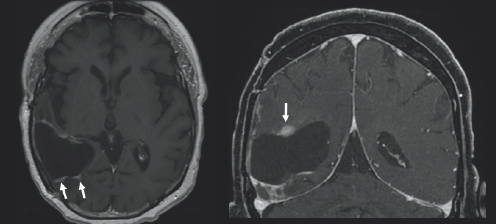 (Left) There is charcoal grey color surrounded by black space and a thin light grey outline. On the left side of the image, there is a black blob with two small white blobs beneath it which are highlighted by two small white arrows. (Right) There is charcoal grey color surrounded by black space and a thin light grey outline. On the left side of the image, there is a black blob with a white spherical figure above it with is highlighted by a small white arrow.