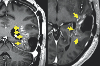 (Left) Gray colored variations are enclosed by black and white outlines. To the right of the center of the image, there is a white blob with gray variations highlighted by four yellow arrows on the left side of the blob. (Right) Gray variations are enclosed by black and white outlines. There is a white blob with variations of gray surrounding it on the right side of the image. This blob is highlighted by three yellow arrows.