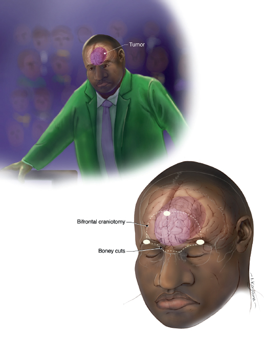 A medical illustration show a man stadning up. His brian is visible and outlines and arrows indicate where incisions for a bifrontal craniotomy are made.