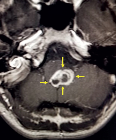A white colored blob is shown the center of the image. It is highlighted by four yellow arrows on each side. There are two dark gray circular structures beneath the white blob. Additional structures are shown with a very light gray outline surrounding them.
