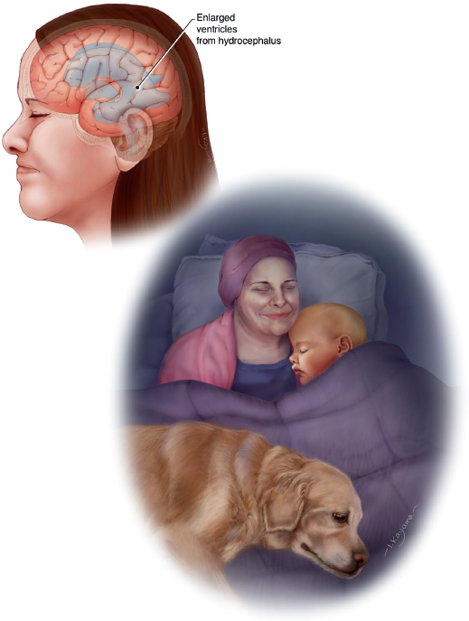 (Left) The left side profile of a woman with brown hair is translucent. There is a pink brain inside her head with expanding blue colored areas. (Right) A woman and a child are lying against pillows in bed under a purple blanket. She is wearing a dark pink beanie, a navy top, and a pink rob. The child is snuggled against her right side. A golden retriever dog is lying on top of the blanket on the woman.