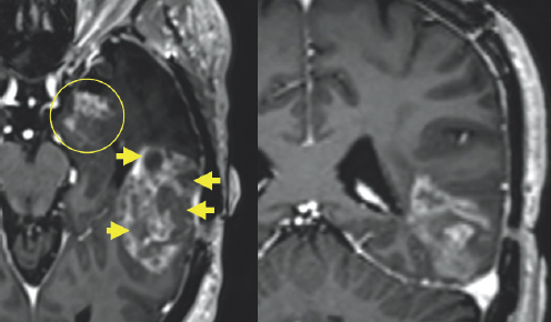(Left) Two light gray colored blobs are surrounded by varying dark gray structures. These white blobs have gray spots on them. The first is located in the center of the image and is highlighted by a yellow circle. The other is located towards the right of the image and is highlighted by four small yellow arrows. (Right) A white ribbon-like figure is shown towards the right of the image. It is surrounded by variations of gray color enclosed by a black and white outline.