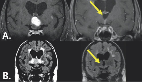 (Left top) A white blob is in the center of the figure. It is surrounded by gray colored variations contained within a black and dark gray boarder. (Right top) A yellow arrow points to a dark gray colored blob in the center of the image. It is surround by gray colored variation. (Left bottom) A white colored region resembling an 'X' surrounds a black butterfly-looking structure. It is surrounded by light gray coloration which is contained within a black and white boarder. (Right bottom) A yellow arrow points to a slightly darker gray region than the surrounding light gray coloration. It is surrounded by a black and white outline.