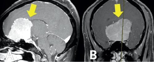 (Left) A white blob within a gray space is highlighted by a yellow arrow on the left side of the image. The white blob is surrounded by gray space, which is enclosed by a white outline. (Right) A light gray colored blob within a dark gray space is highlighted by a yellow arrow in the center of the image. It is enclosed by a black circle and white outline.