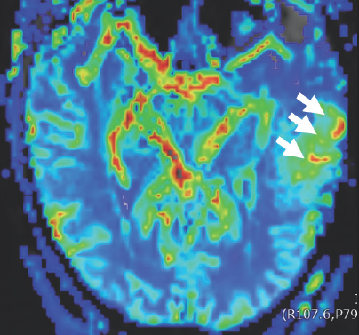 Dark blue, green, light blue, orange, red, and yellow colors are scattered within a blue boarder. Three white arrows point to a green blob on the right side of the image that has two sickled ovals that are red, orange, and yellow in color.