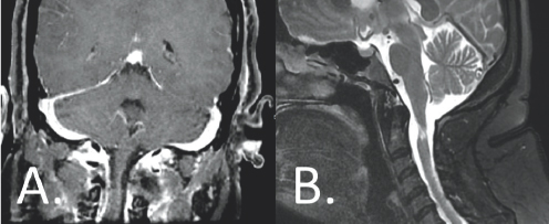 (Left) Gray and white color variations are surrounded by a gray outline. There is a gray colored column attaching a large gray space to the bottom of the image. (Right) A light grey vertical column is shown surrounded by white coloration from the bottom to the top of the image. There are other gray structures present, all of which are enclosed by a dark gray outline.
