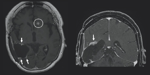 (Left) There is charcoal grey color surrounded by black space and a thin light gray outline. There is a black colored blob in the bottom left side of the image with three white blobs around it; two on the bottom and one on the top. Each white blob is highlighted by white arrows. There is a small light gray circle to slightly to the right of the center of the image. It is circled in white. (Right) There is charcoal grey color surrounded by black space and a thin light gray outline. On the left side of the image, there is a black blob with a white colored blob on top of it. There is a white arrow pointing downward towards the white blob.