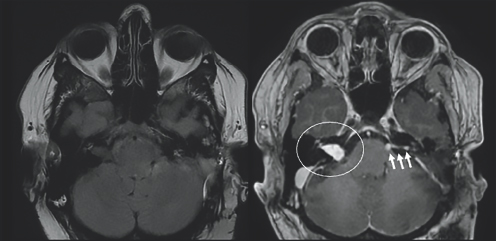 (Left) Dark gray colored structures are contained within a light gray outline. (Right) A white colored blob on the left side of the image is highlighted by a white circle. There is a white horizontal blob on the right side of the figure highlighted by three small white arrows. These blobs are located just above two conjoined gray spherical structures. All structures are enclosed by a gray outline.