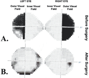(Top) Two graphs are shown with circular shading. The leftmost graph has dark shading on the top quadrants of the left side with decreasing darkness in the bottom quadrant. The rightmost graph has complete black coloration on the top and bottom quadrants of the right side. (Bottom) Two graphs are shown with circular shading. The leftmost graph has darkening coloration towards the outline of the circle in all four quadrants. The rightmost graph has a singular darkening region in the bottom right quadrant near the outline of the circle.